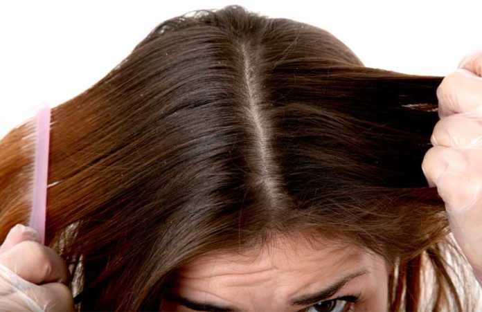 5 Home Remedies to Get Rid of Dandruff