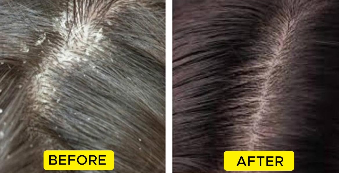 How to Remove Dandruff from Hair?